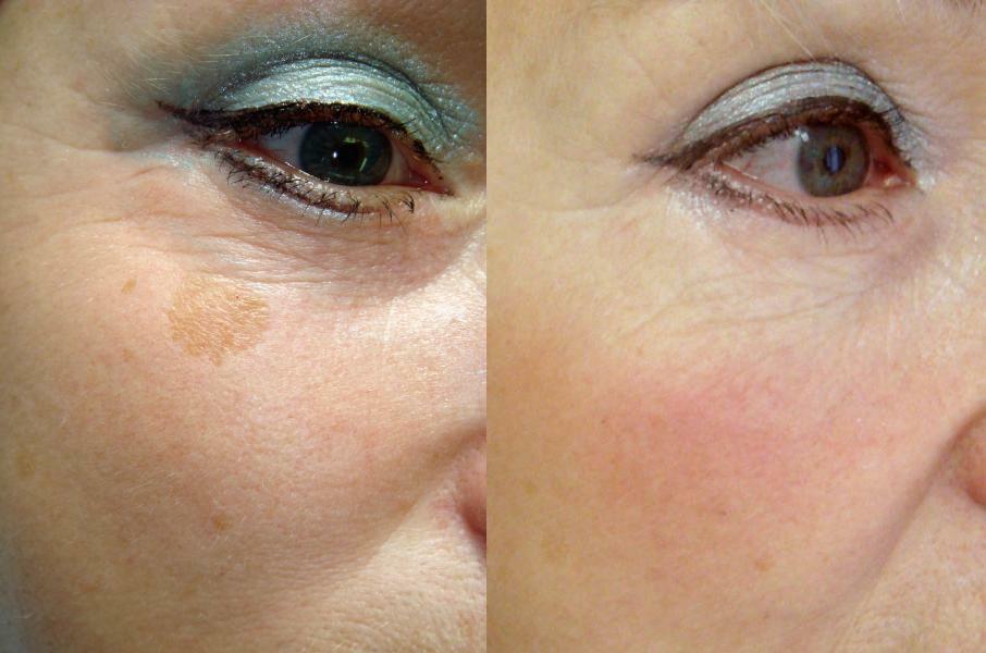 Как вывести пигментное пятно на лице при сухой коже в домашних условиях