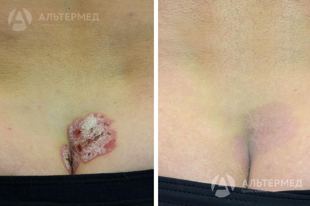 Экзема сухая лечение лекарства