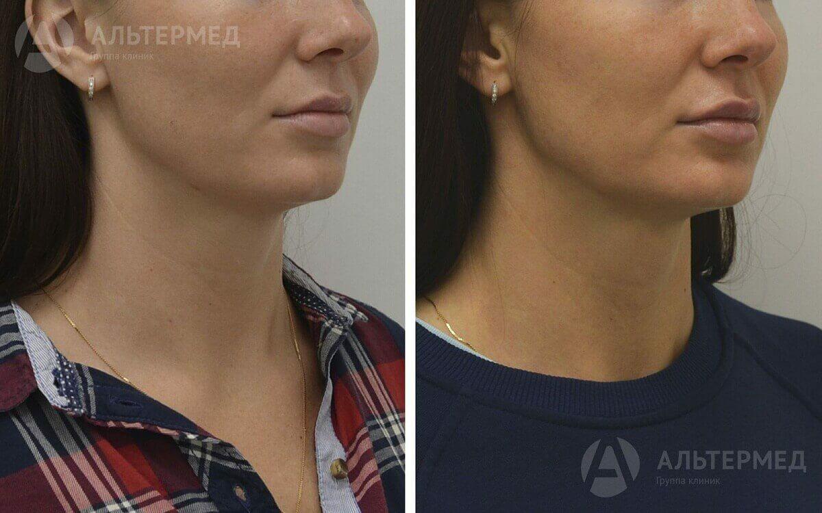 коррекция и увеличение груди коррекция и увеличение груди