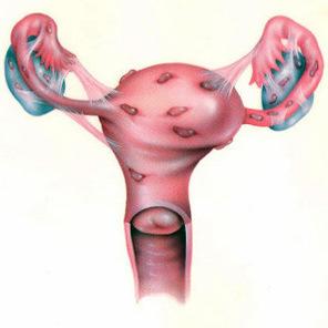 Эндометриоз endometrioz_-_1_abzac.jpg