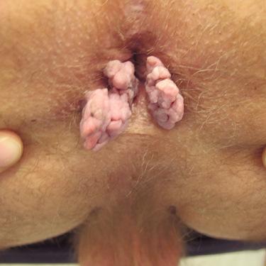 Генитальные бородавки (остроконечные кондиломы) borodavki_-_genital_nnye_borodavki_ostrokonechnye_kondilomy.jpg