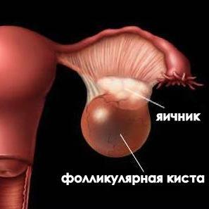 Киста яичника kista_yaichnika.jpg
